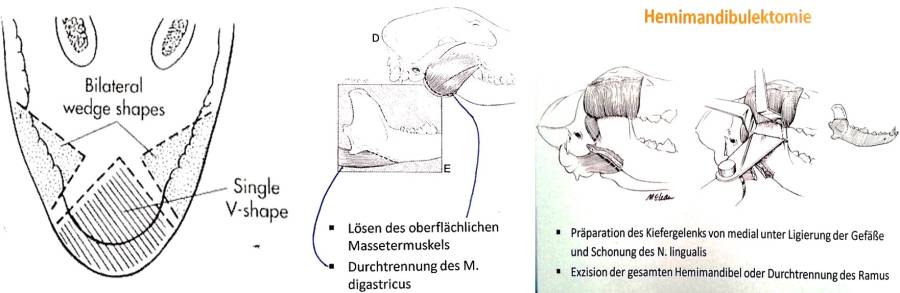 mandibulektomie_-_kessler_.jpg