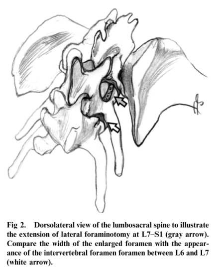 neurochirurgie_-_foraminotomie_goedde_steffen_2007_.jpg