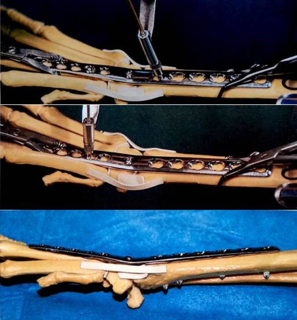 op_-_arthrodese_karpalgelenk.jpg op_-_arthrodese_karpalgelenk.jpg