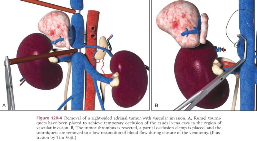 op_-_nebennierentumorresektion_mit_gefaessinvasion_tobias_johnston_2012_.jpg