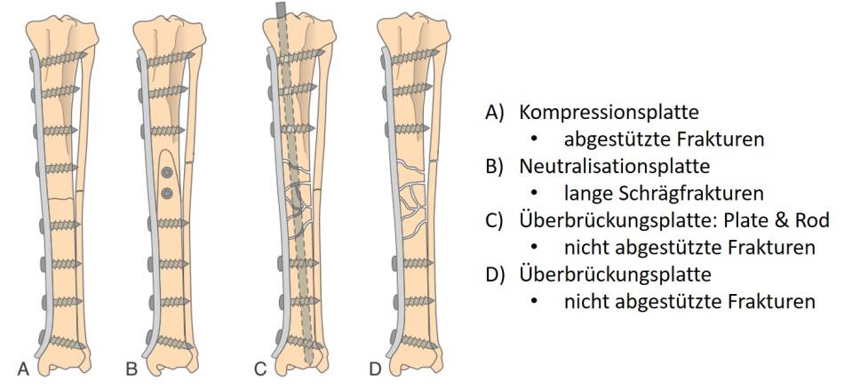 op_-_tibiafraktur_-_diaphysenfraktur_prinzipien_fossum_2013_.jpg
