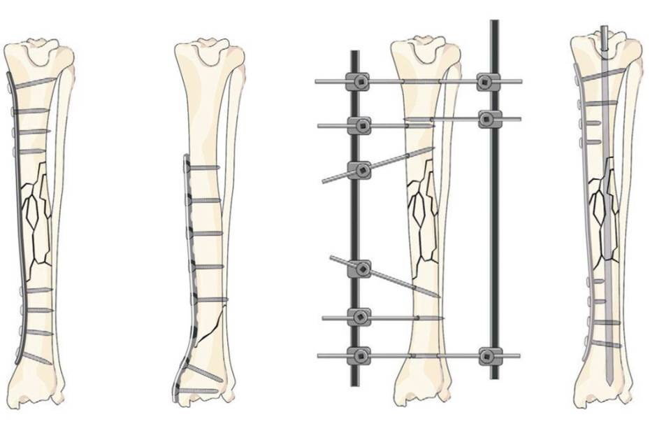 op_-_tibiafraktur_-_diaphysenfraktur_versorgung_fossum_2013_.jpg
