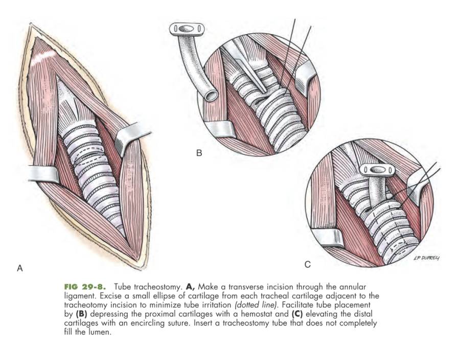 op_-_tracheotomie_fossum_2013_.jpg
