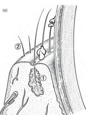 ophthalmologie_-_distichiasis_schema_stades_et_al._2007_.jpg