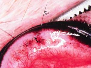 ophthalmologie_-_ektopische_zilien_foto_walde_et_al._2008_.jpg