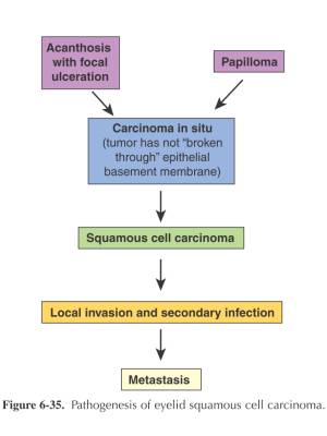 ophthalmologie_-_lidtumor_squamoeses_karzinom_maggs_et_al._2008_.jpg