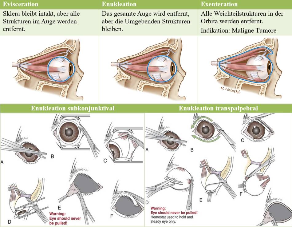 ophthalmologie_op_-_enukleation_maggs_et_al._2008_.jpg