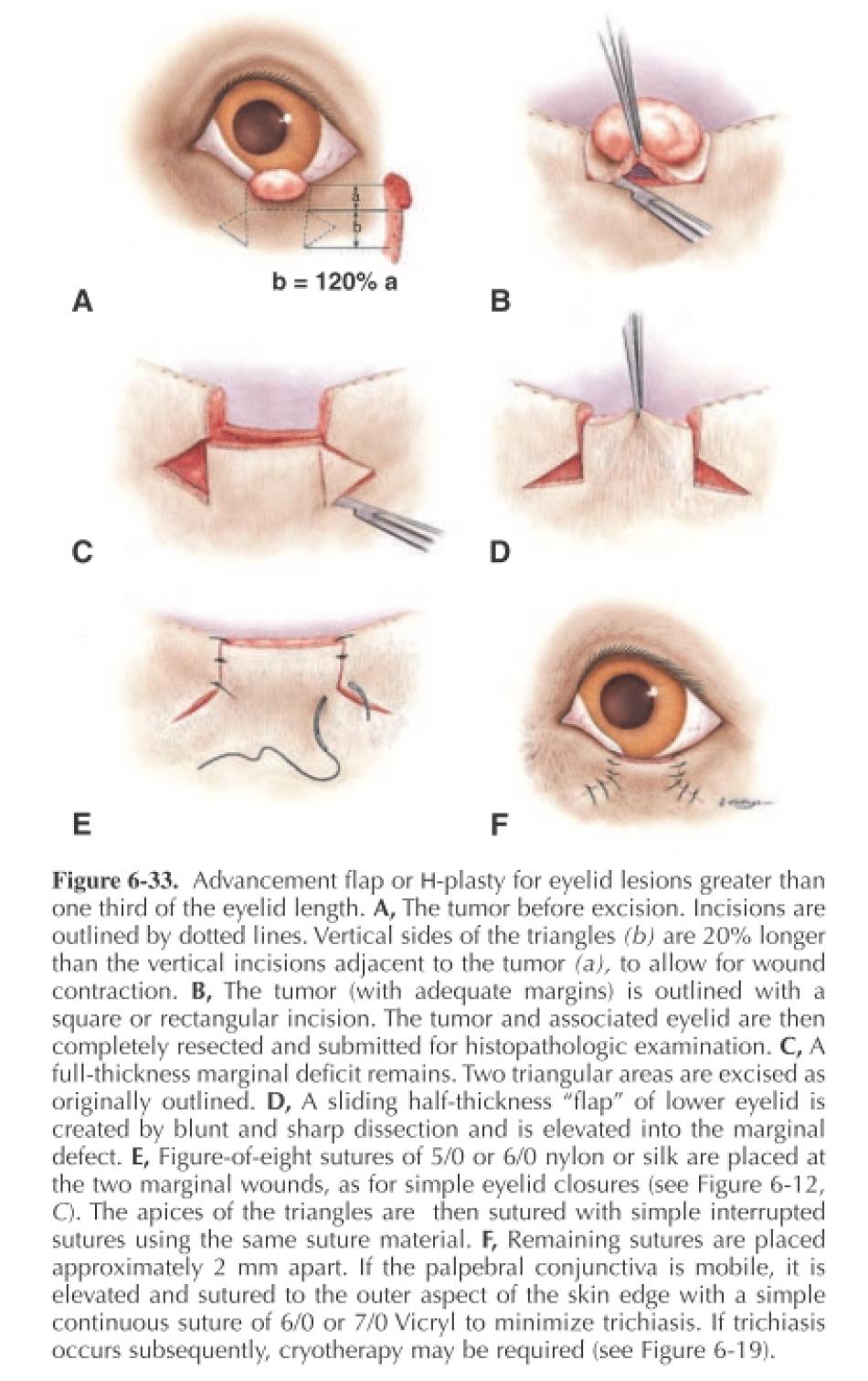 ophthalmologie_op_-_lidrandtumor_schiebelappenplastik_maggs_et_al._2008_.jpg