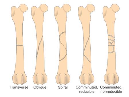 orthopaedie_-_frakturtypen_roehrenknochen_fossum_2013_.jpg