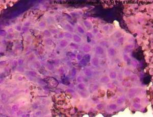 zytologie_prostatakarzinom_hund_m2_2014_.jpg