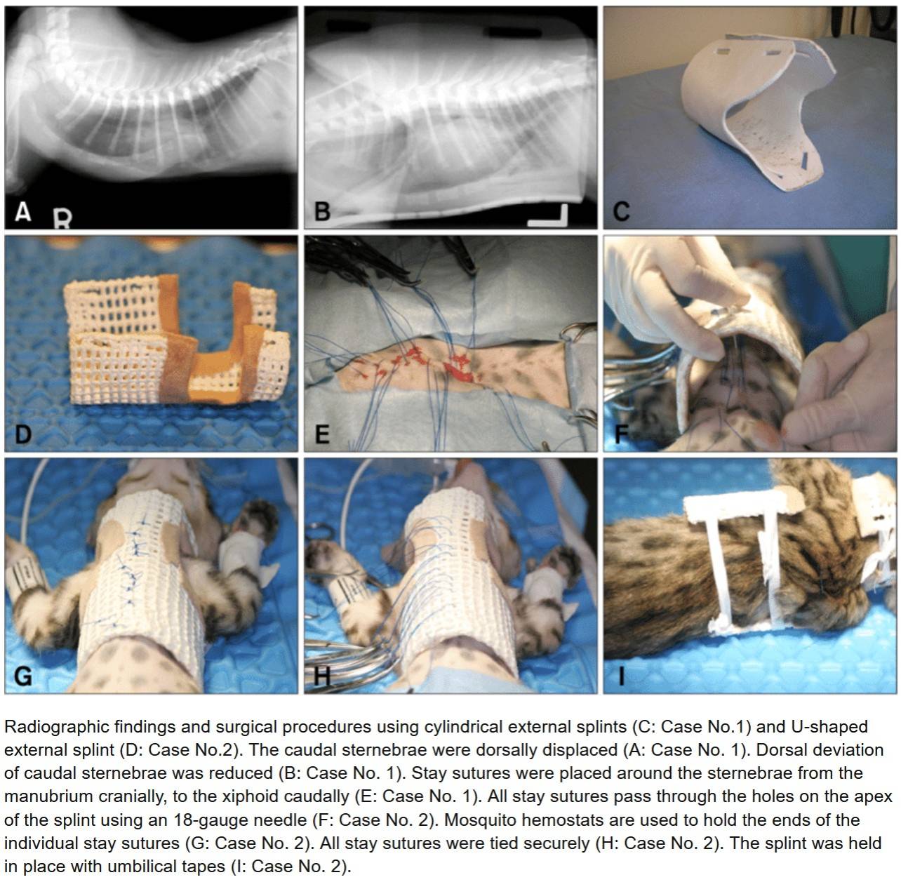 Pectus Excavatum Externer Splint Pectus Excavatum Externer Splint