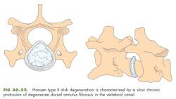 orthopaedie_-_bsv_hansen-typ-2_fossum_2013_.jpg orthopaedie_-_bsv_hansen-typ-2_fossum_2013_.jpg