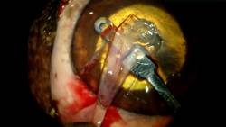 opthalmologie-cctcorneoconjunctivaltransposition.jpg opthalmologie-cctcorneoconjunctivaltransposition.jpg