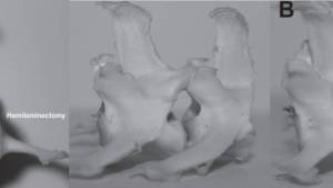 neurochirurgie_-_hemilaminektomie_vs._minihemilaminektomie.jpg neurochirurgie_-_hemilaminektomie_vs._minihemilaminektomie.jpg