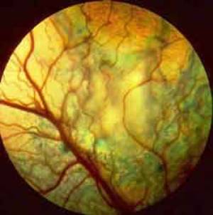 opthalmologie-netzhautdysplasie.jpg opthalmologie-netzhautdysplasie.jpg