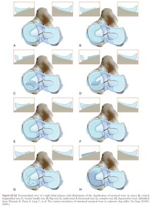 Meniscusschaden Typ (Tobias & Johnston, 2012) Meniscusschaden Typ (Tobias & Johnston, 2012)