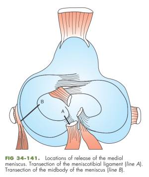 Meniscus-Release (Fossum, 2013) Meniscus-Release (Fossum, 2013)