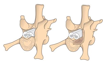 neurochirurgie_-_korpektomie_1_fossum_2013_.jpg neurochirurgie_-_korpektomie_1_fossum_2013_.jpg