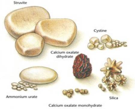 Harnsteine Harnsteine