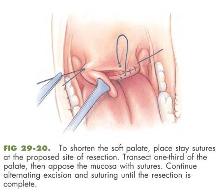 op_gaumensegelkuerzung_fossum_2013_.jpg op_gaumensegelkuerzung_fossum_2013_.jpg