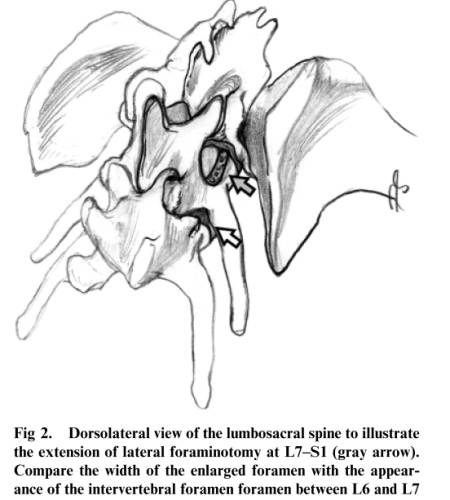neurochirurgie_-_foraminotomie_goedde_steffen_2007_.jpg neurochirurgie_-_foraminotomie_goedde_steffen_2007_.jpg