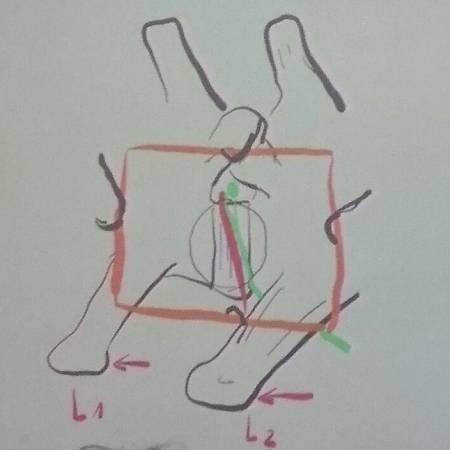 neurochirurgie_-_korpektomie_3_forterre_2017_.jpg neurochirurgie_-_korpektomie_3_forterre_2017_.jpg