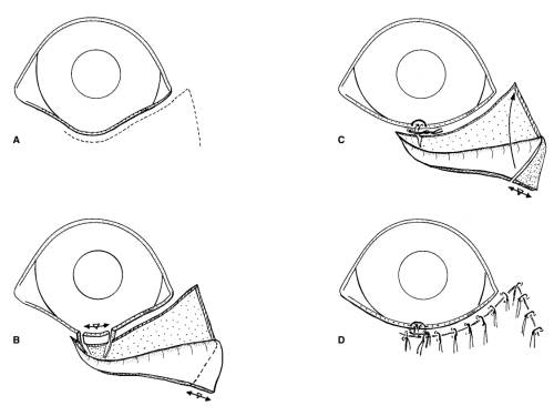 ophthalmologie_op_-_ektropium_kuhnt-szymanovsky-methode_stades_2007_.jpg ophthalmologie_op_-_ektropium_kuhnt-szymanovsky-methode_stades_2007_.jpg
