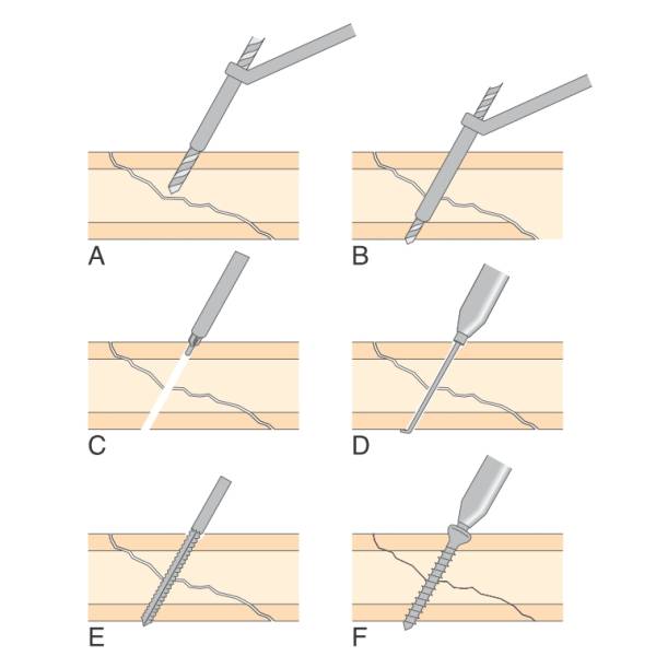 osteosynthese_-_zugschraube_tobias_johnston_2012_.jpg osteosynthese_-_zugschraube_tobias_johnston_2012_.jpg