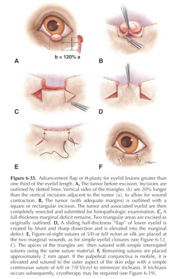 ophthalmologie_op_-_lidrandtumor_schiebelappenplastik_maggs_et_al._2008_.jpg ophthalmologie_op_-_lidrandtumor_schiebelappenplastik_maggs_et_al._2008_.jpg