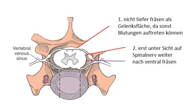 neurochirurgie_-_fasettektomie_m2_2018_.jpg neurochirurgie_-_fasettektomie_m2_2018_.jpg