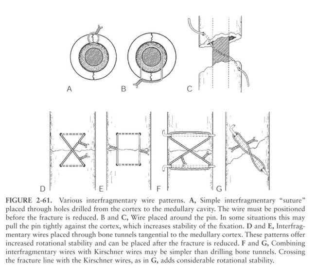 op_-_cerclagen_interfragmentaer_decamp_2016_.jpg op_-_cerclagen_interfragmentaer_decamp_2016_.jpg
