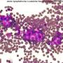 zytologie_lymphatische_leukaemie_m2_2016_.jpg