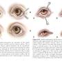 ophthalmologie_op_-_entropium_nasale_kantoplastik_maggs_et_al._2008_.jpg