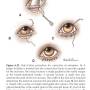 ophthalmologie_op_-_entropium_hotz-celsus_maggs_et_al._2008_.jpg