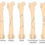 orthopaedie_-_frakturtypen_roehrenknochen_fossum_2013_.jpg