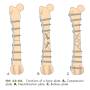 osteosynthese_-_verplattungsarten_tobias_johnston_2012_.jpg