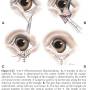 ophthalmologie_op_-_ektropium_y-blepharoplastik_maggs_et_al._2008_.jpg