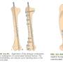 op_-_humerus_-_diaphysenfraktur_fossum_2013_permattei_2017_.jpg