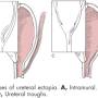 op_-_ektopische_ureteren_formen_fossum_2013_.jpg