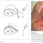 ophthalmologie_op_-_entropium_stades-methode_stades_2007_.jpg