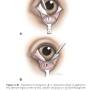 ophthalmologie_op_-chalizion_maggs_et_al._2008_.jpg