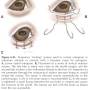 ophthalmologie_op_-_temporaer_entropium_maggs_et_al._2008_.jpg