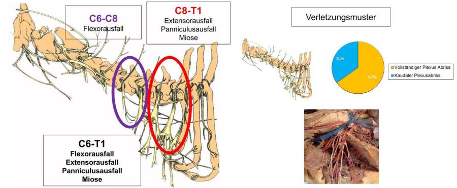 Schema Plexusabriss (Forterre, 2021) Schema Plexusabriss (Forterre, 2021)