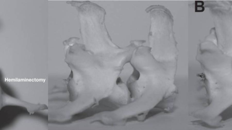 neurochirurgie_-_hemilaminektomie_vs._minihemilaminektomie.jpg neurochirurgie_-_hemilaminektomie_vs._minihemilaminektomie.jpg