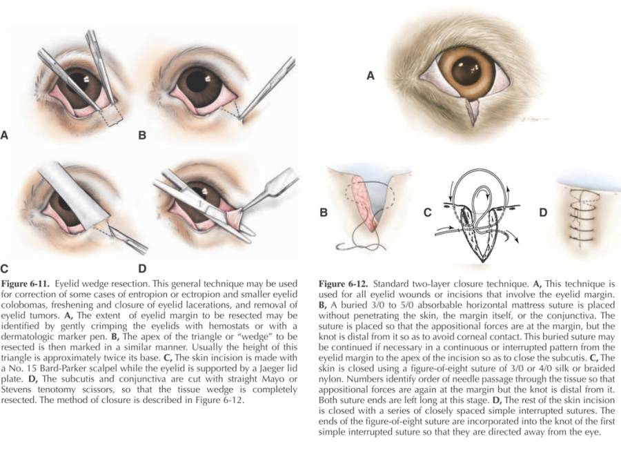 ophthalmologie_op_-_lidrandtumor_wedgeresektion_maggs_et_al._2008_.jpg ophthalmologie_op_-_lidrandtumor_wedgeresektion_maggs_et_al._2008_.jpg