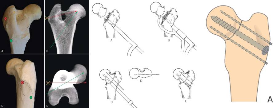 op_-_femurfraktur_-_femurhalsfraktur_mit_zugschraube_und_pins_tobias_2012_piermattei_2017_fossum_2013_.jpg op_-_femurfraktur_-_femurhalsfraktur_mit_zugschraube_und_pins_tobias_2012_piermattei_2017_fossum_2013_.jpg