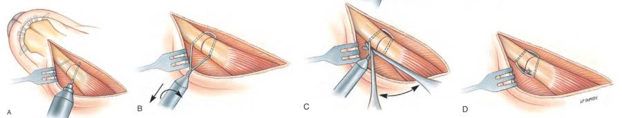 op_-_unterkieferfraktur_cerclage_fossum_2013_.jpg op_-_unterkieferfraktur_cerclage_fossum_2013_.jpg