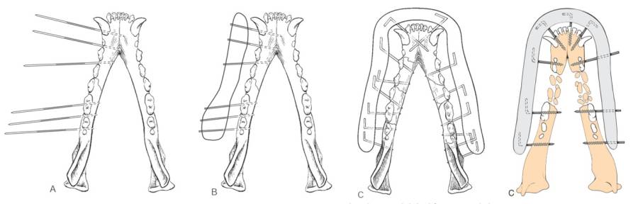 op_-_unterkieferfraktur_pinning_1_piermattei_et_al._2017_.jpg op_-_unterkieferfraktur_pinning_1_piermattei_et_al._2017_.jpg