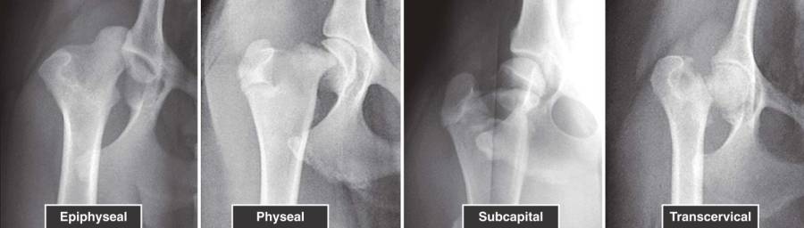 op_-_femurfraktur_-_proximale_femurfraktur_klassifizierung_tobias_2012_.jpg op_-_femurfraktur_-_proximale_femurfraktur_klassifizierung_tobias_2012_.jpg