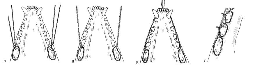 op_-_interdental_wiring_2_holmstrom_2007_.jpg op_-_interdental_wiring_2_holmstrom_2007_.jpg